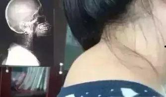 富贵包治疗视频,告别颈肩不适的康复指南