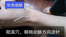 针灸过程视频,一窥传统中医疗法的神奇魅力